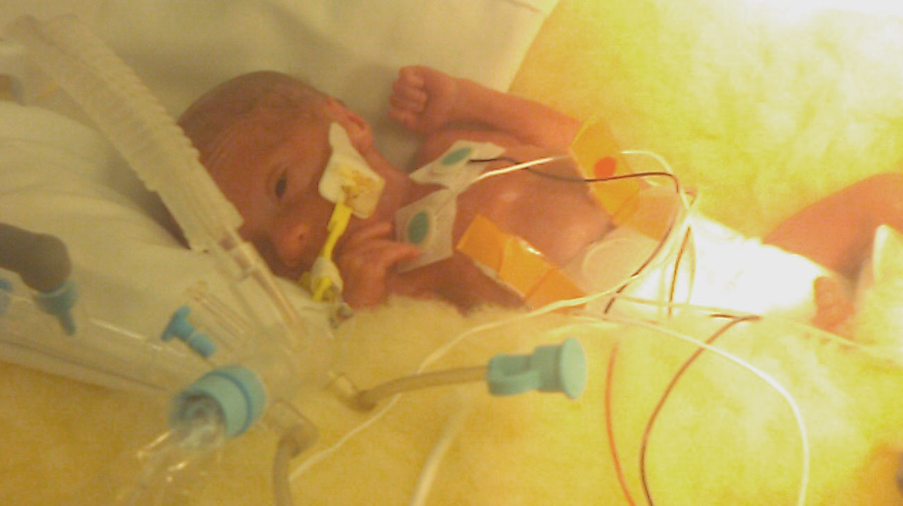 Tylor was born 25 weeks gestation and weighed less than one pound. 