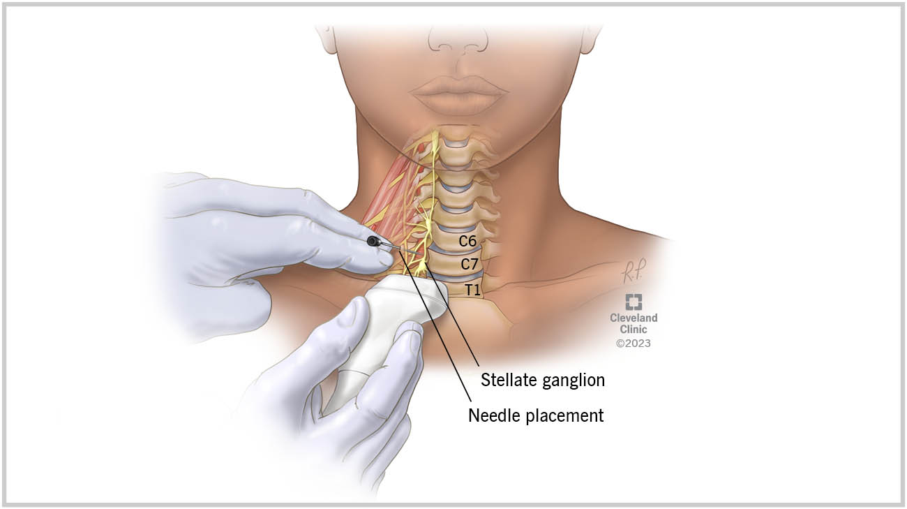 A stellate ganglion block is an injection of medication into a collection of nerves at the bottom of the front side of your neck. 