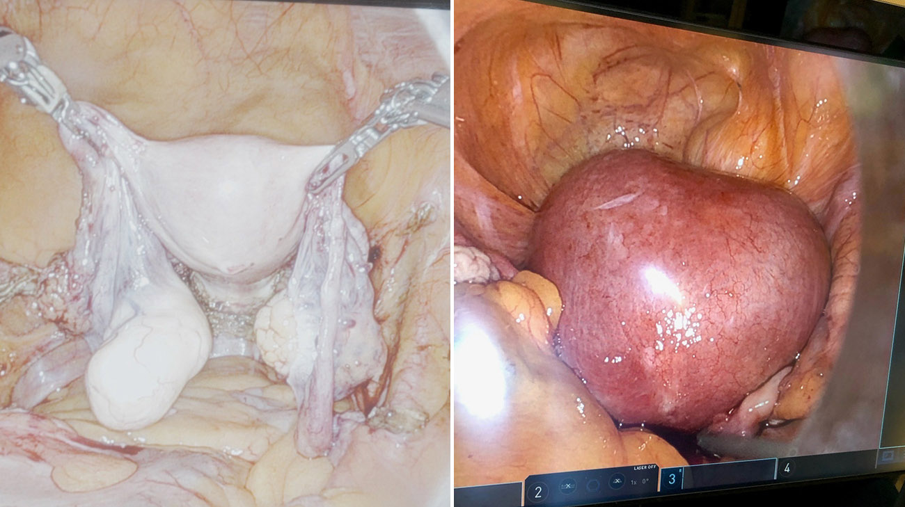 Normal Uterus vs Stephanie's enlarged uterus