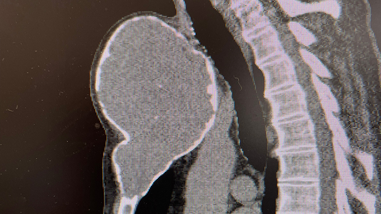 CT imaging shows a cartilage tumor expanding the sternum.