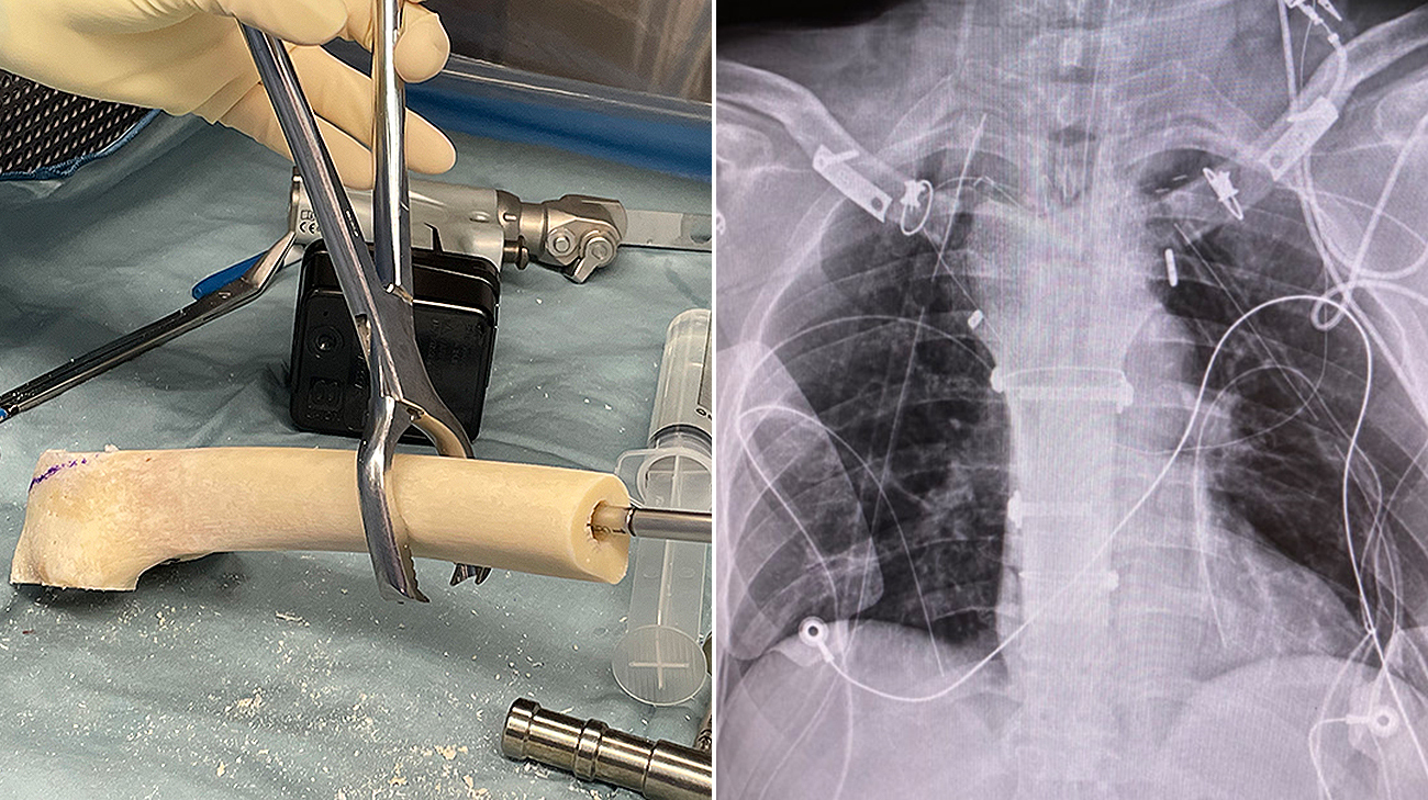 A femoral allograft obtained from a national bone bank, prepared to fit the sternal defect. A chest X-ray shows the final sternal reconstruction.