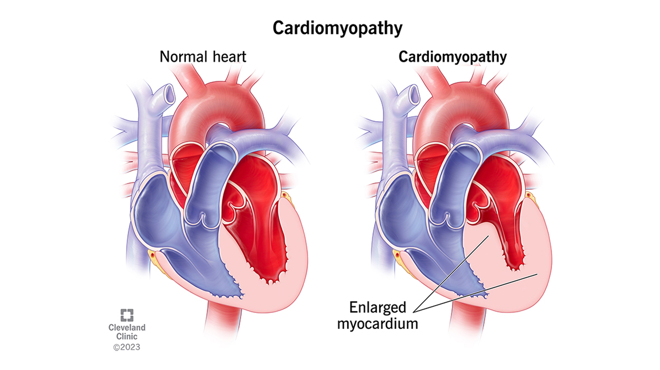 Cleveland Clinic illustration of cardiomyopathy.