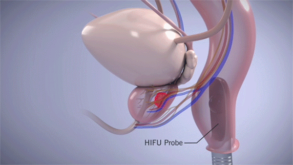 Cleveland Clinic animation for high intensity focused ultrasound treatment for prostate cancer. 