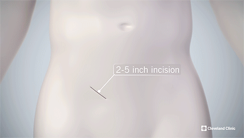 Animation of a mini-incision kidney transplant.