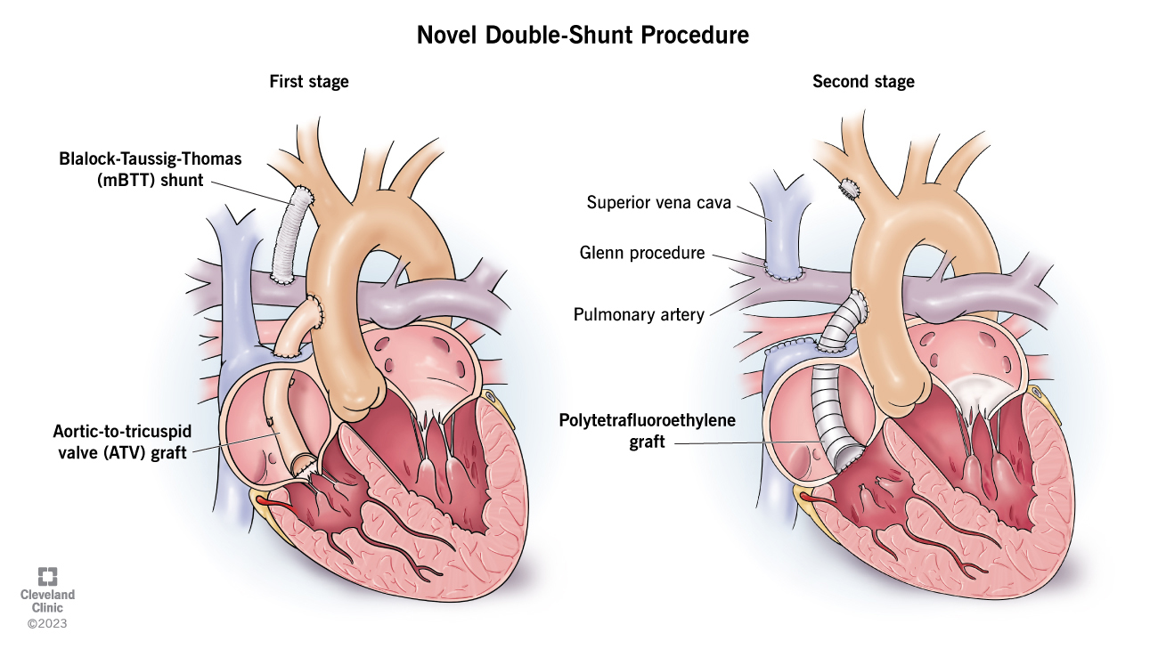Illustration to show Adaya's heart procedure.