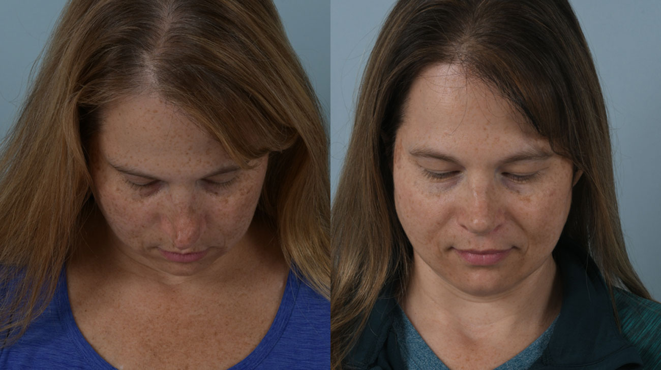 Patient downward view before (left) and after (right) image from septoplasty procedure.
