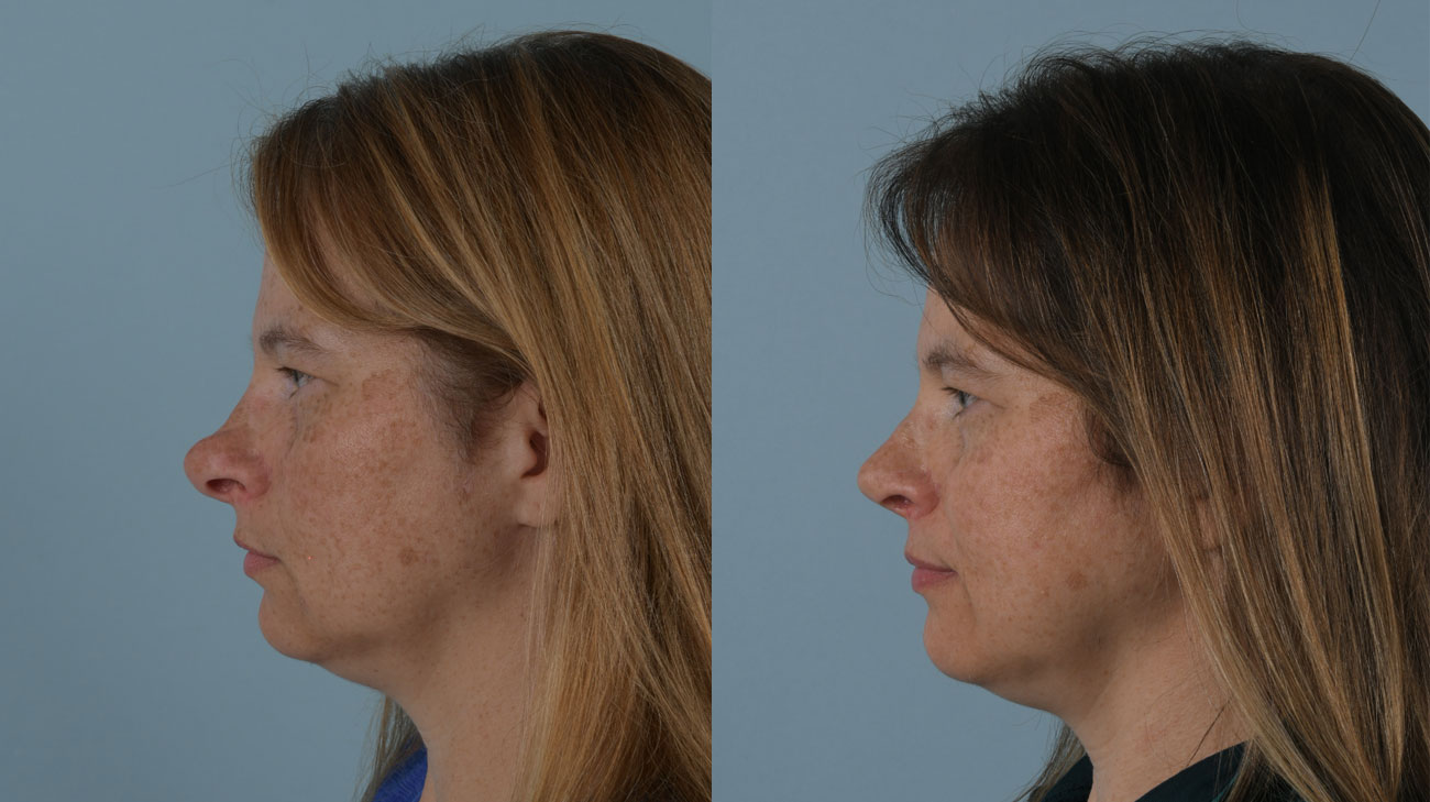 Patient side profile before (left) and after (right) image from septoplasty procedure.