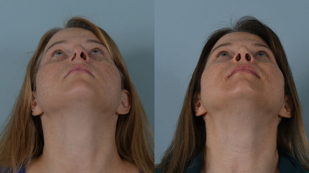 Patient upward view before (left) and after (right) image from septoplasty procedure.