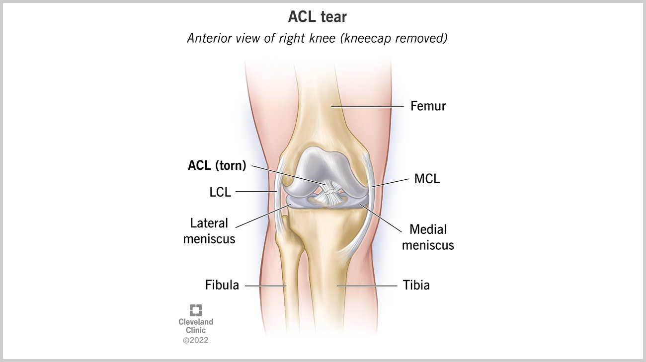 An ACL tear is an injury to the anterior cruciate ligament (ACL) in your knee.