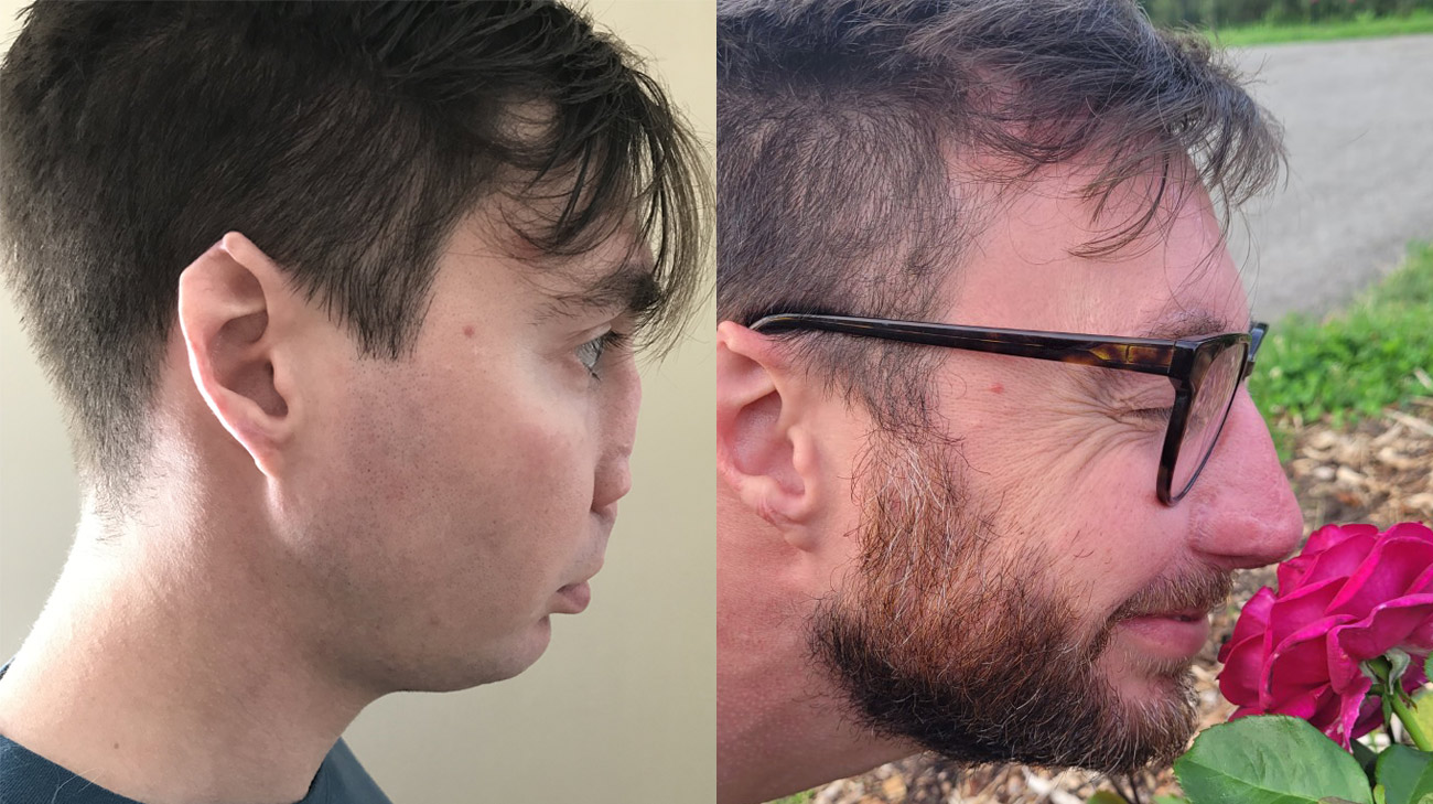 An attack by a dog in 2017 resulted in the amputation of Andrew's nose. Side view, before (left) and after (right) Andrew's nasal reconstruction.