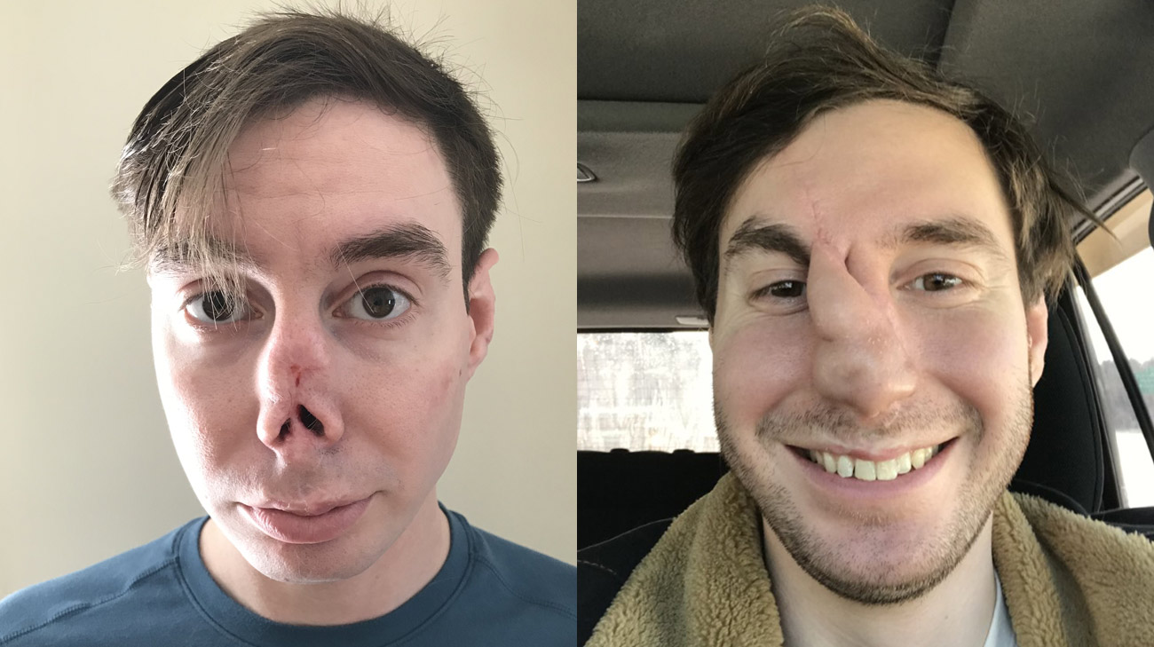 Andrew spent 18 months researching plastic surgeons before choosing Dr. Byrne. Above, Andrew is shown before nasal reconstruction and mid-reconstruction.