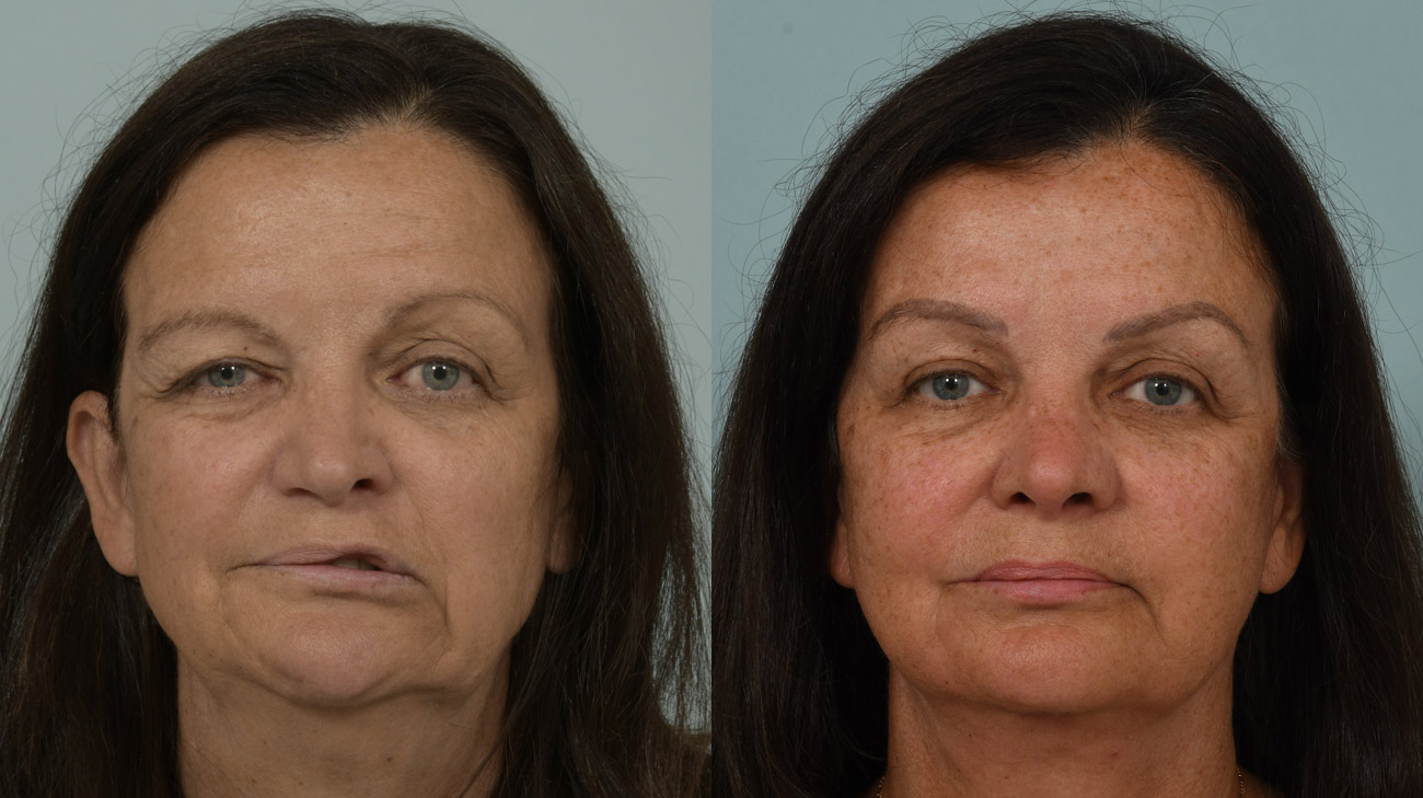 Tami before (left) her facial paralysis procedure and after (right).