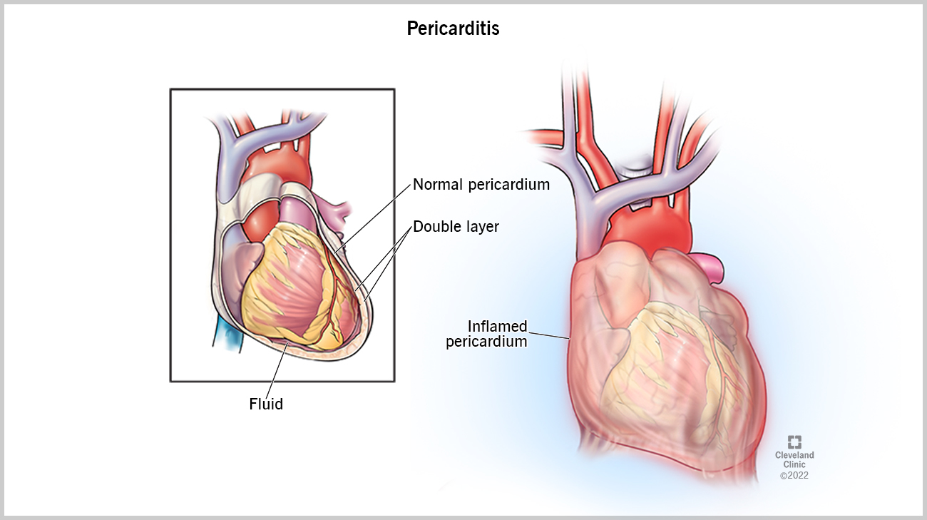 Cleveland Clinic illustration of pericarditis. 