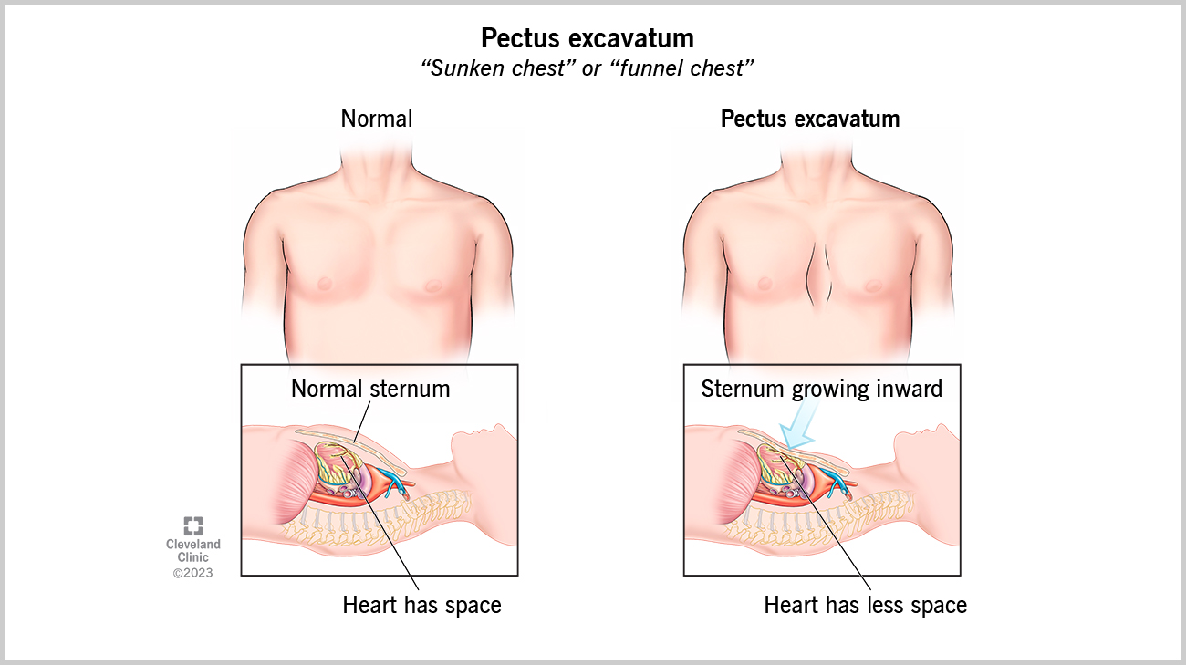 Pectus excavatum illustration.