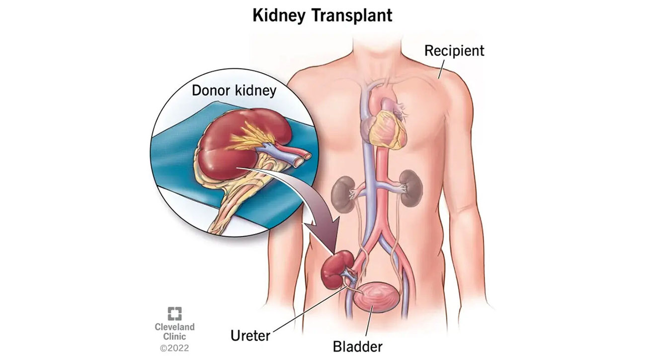 Cleveland Clinic illustration of a kidney transplant. 