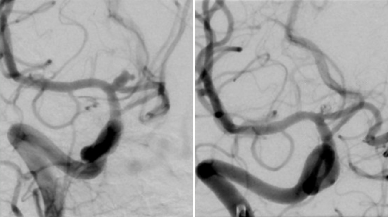 Scan of Julianne's aneurysm