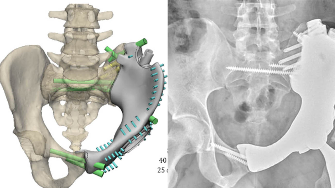 Scans of Rayshaun's 3D-printed custom pelvic implant. 