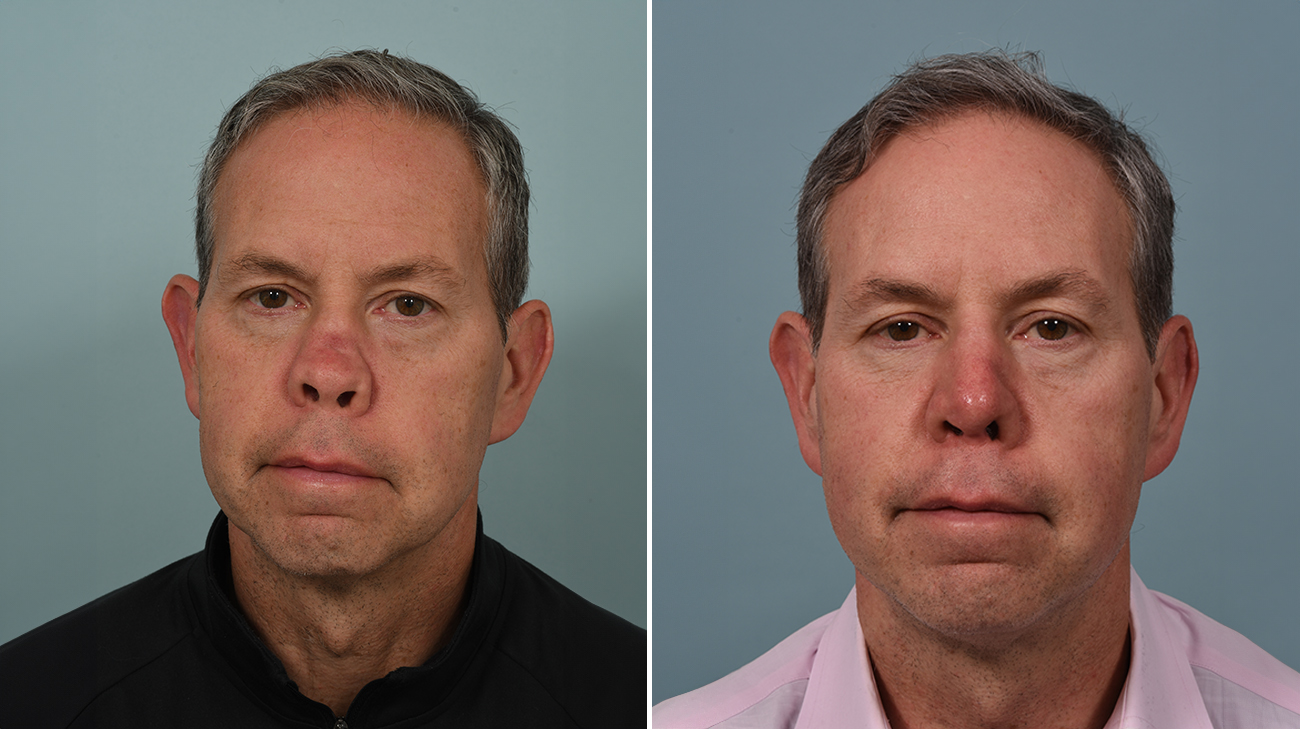 Complications from GPA, a rare autoimmune disease, resulted in external deformities to Josh Kane’s nasal structure (left), which were corrected following nasal reconstruction surgery at Cleveland Clinic (right).