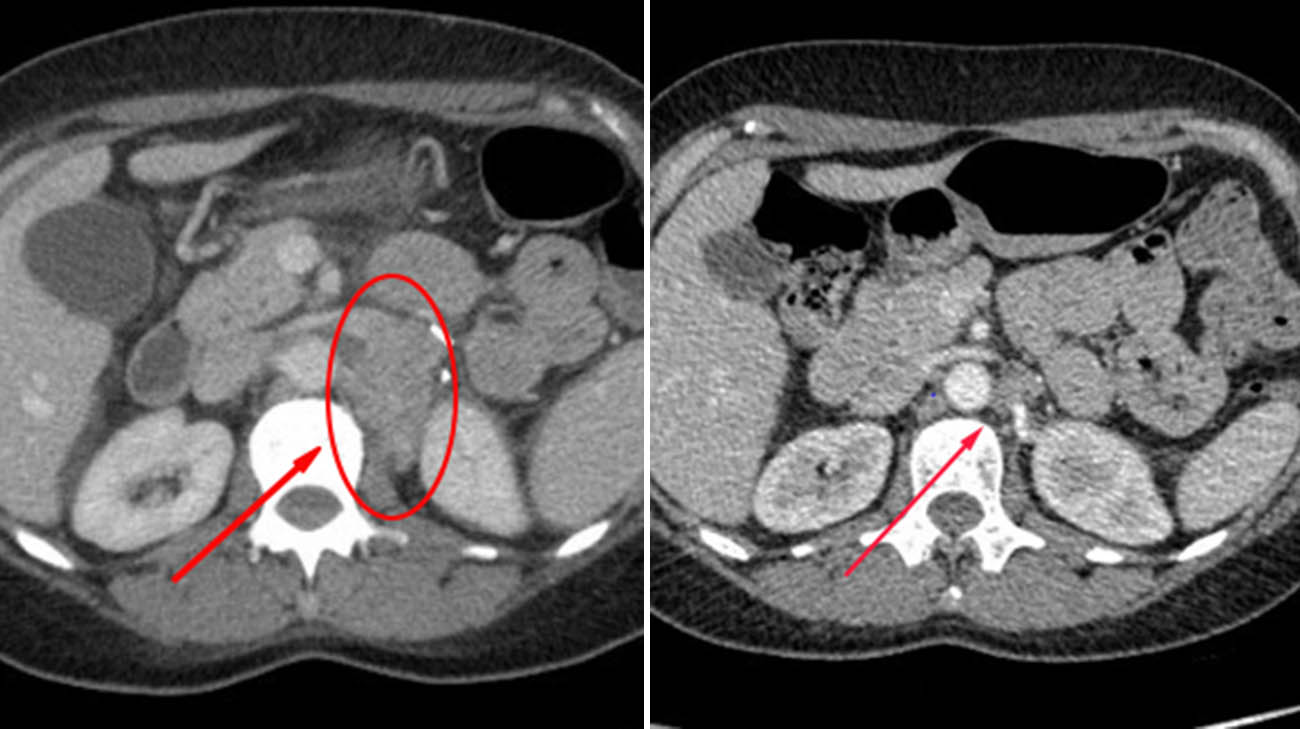 Imaging scans before a patient with melanoma underwent tumor-infiltrating lymphocytes therapy and 12 weeks after receiving the therapy. 