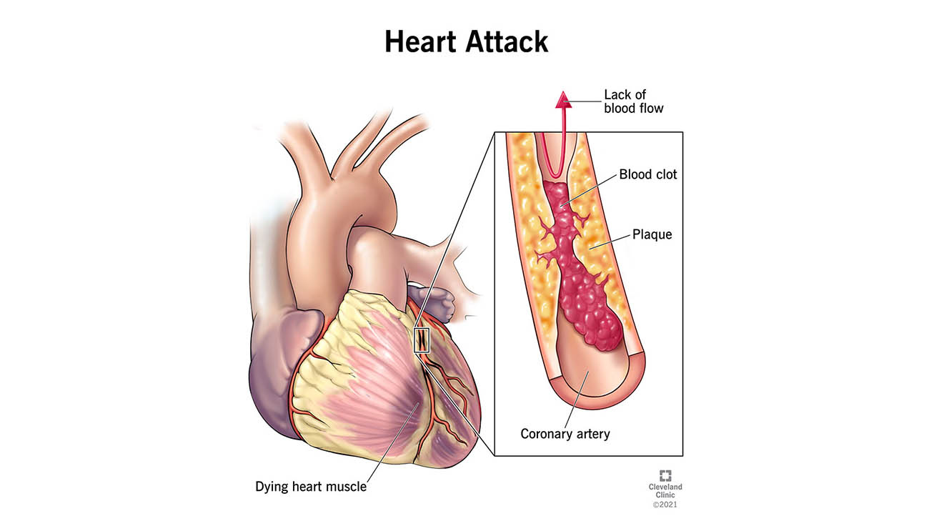 Cleveland Clinic illustration of a heart attack. 