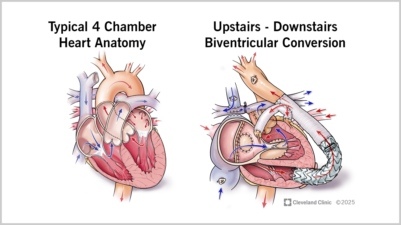 Illustration comparing typical heart to Faith's