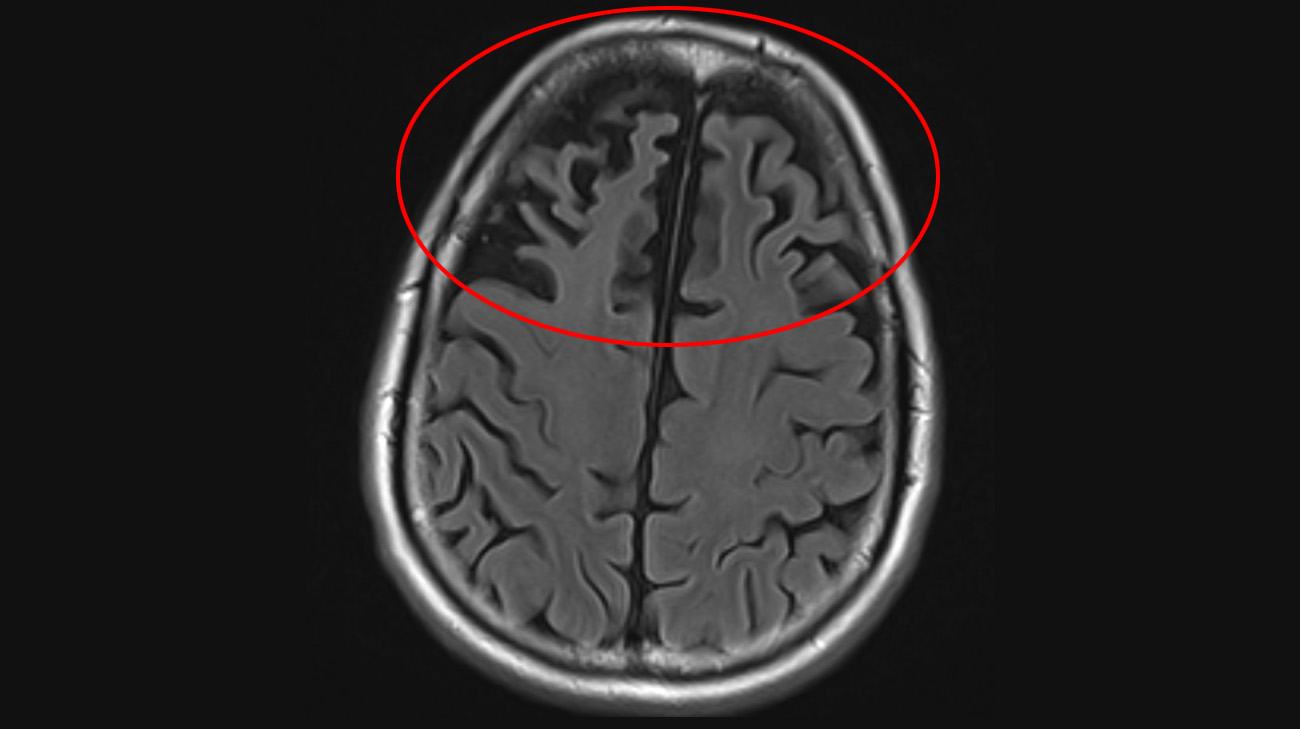 Brain MRI scan