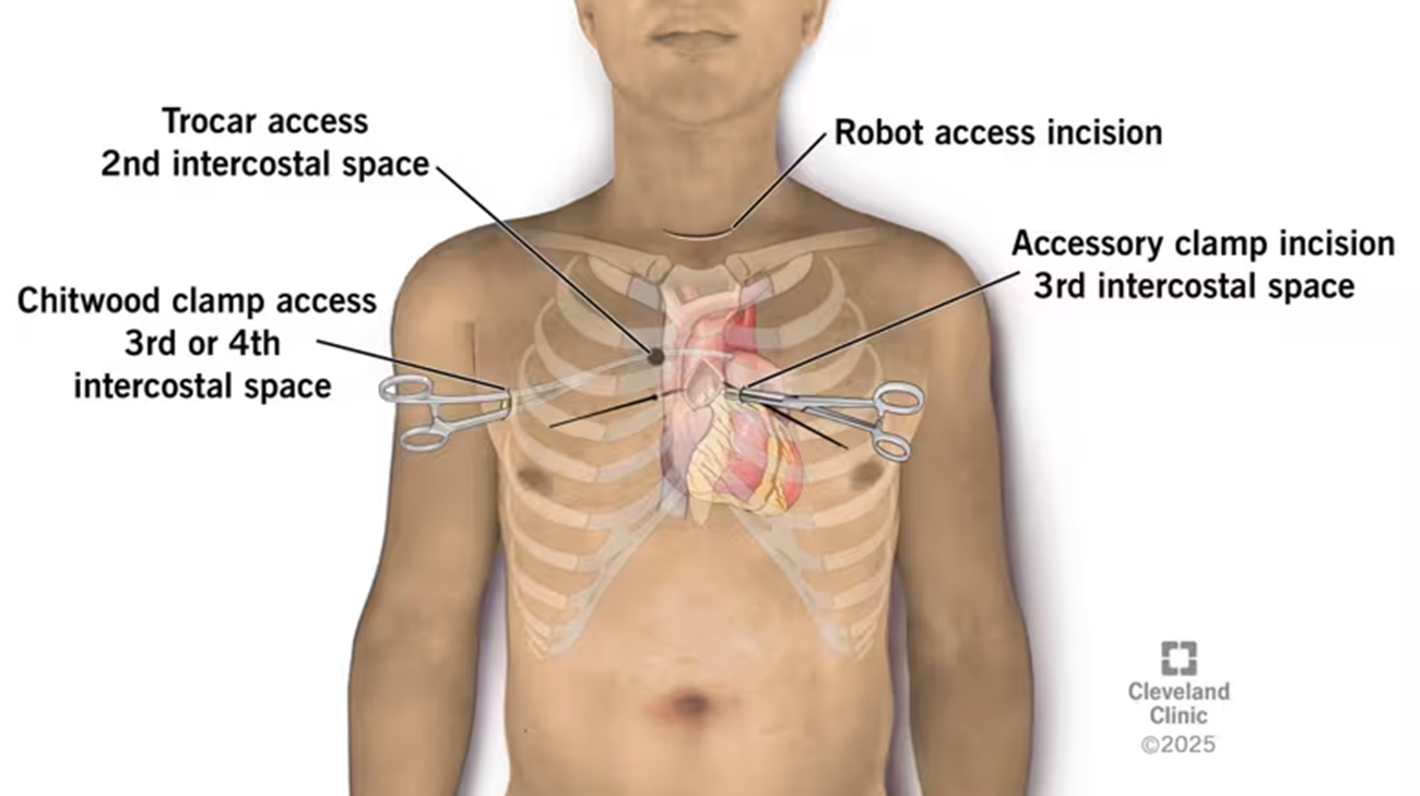 Illustration showing placement of the four incisions in transcervical robotic AVR.