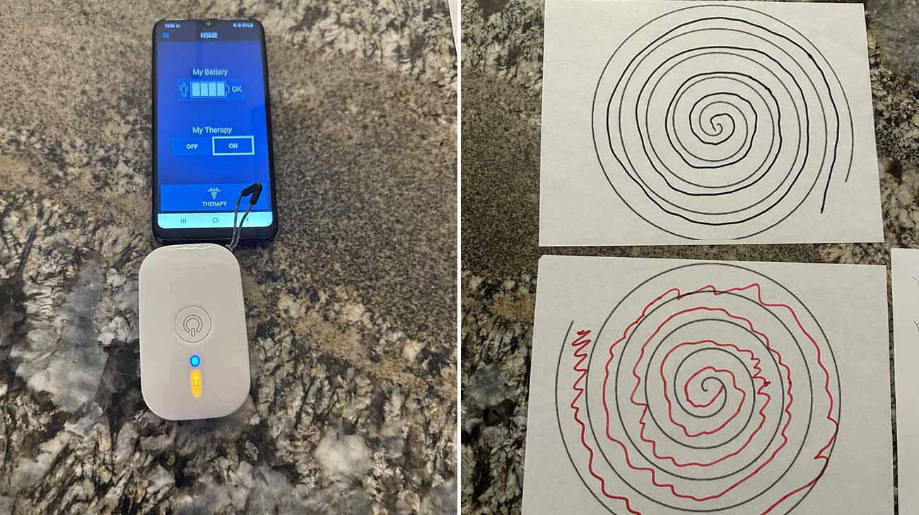 Images showing how the implanted device helps Mary with her tremors.