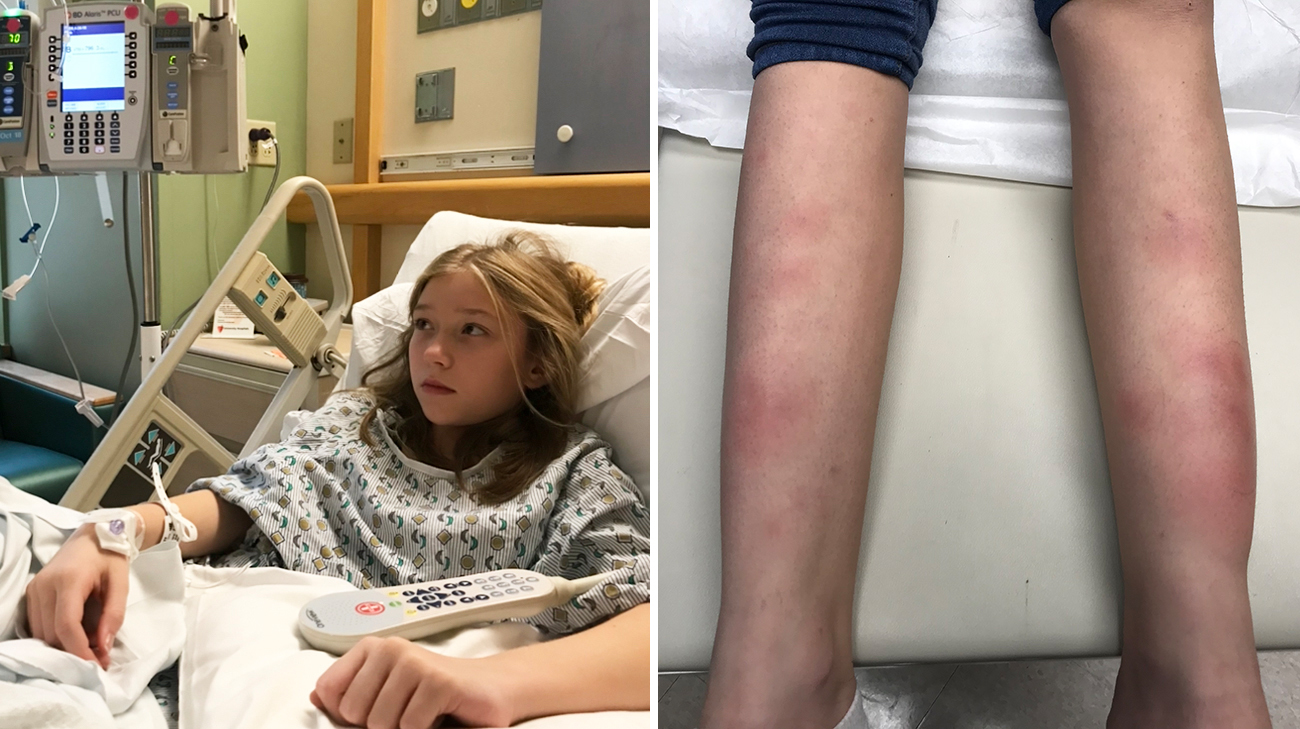 Scarlette developed patches on her legs because of sarcoidosis. 