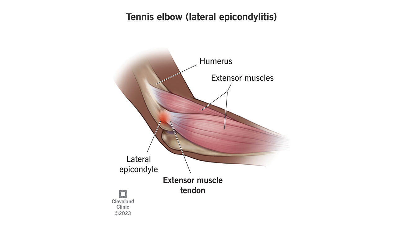 Cleveland Clinic illustration of tennis elbow. 