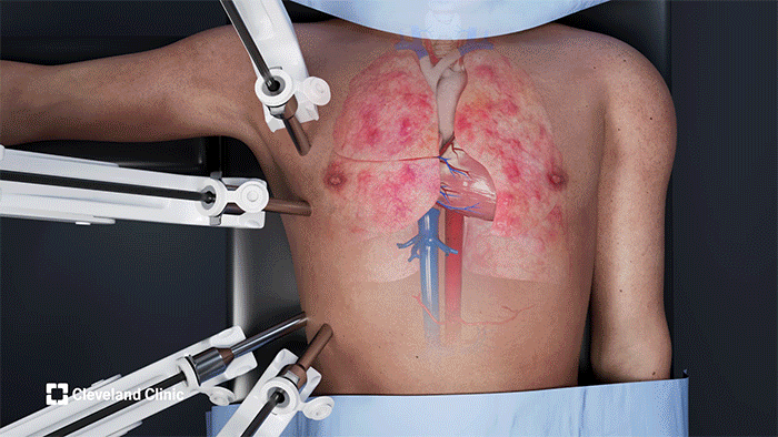 Animation of robotic lung transplant