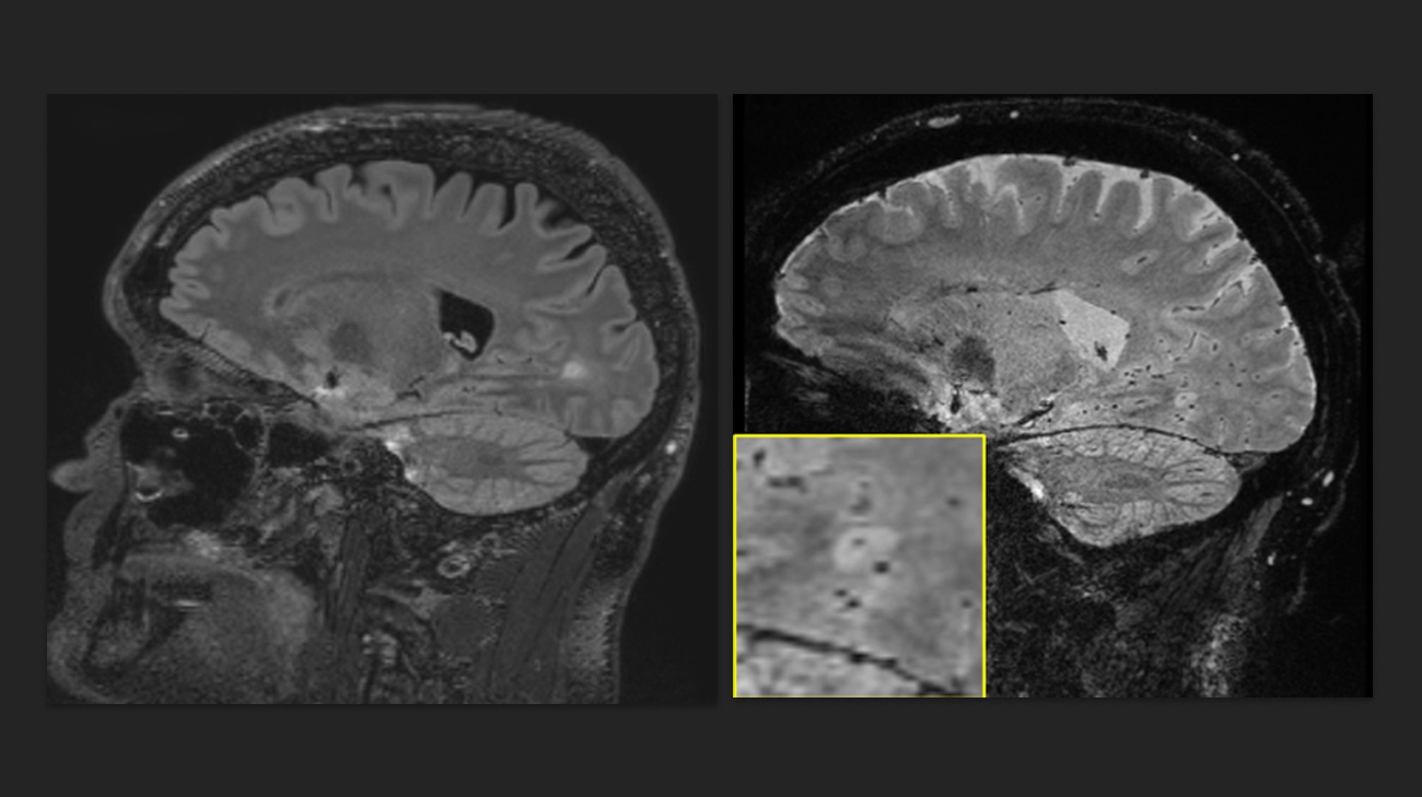 MRI scans of Robert's brain during his participation in the Cleveland Clinic Brain Study.