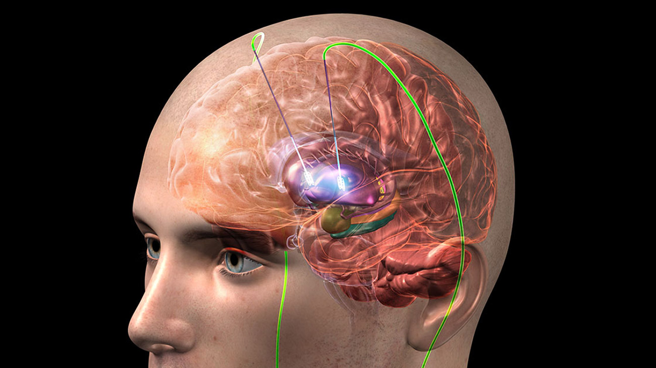 During Deep Brain Stimulation, electrodes are implanted in the brain, which deliver electrical impulses that block or change the abnormal activity that cause symptoms. (Courtesy Cleveland Clinic)