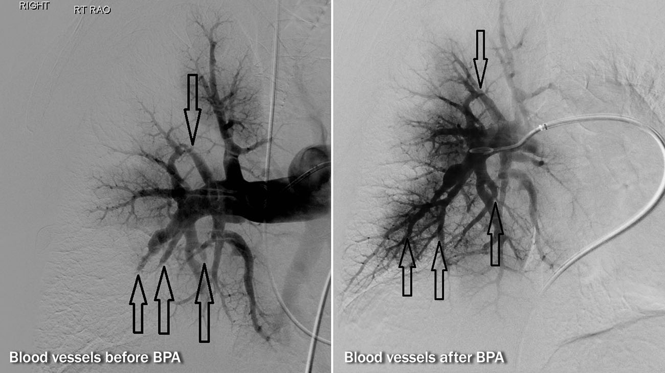 Peggy’s pulmonary angiogram: Left image demonstrates blocked vessels with no blood flow past the arrows. Right image shows improved blood flow (after BPA) past the arrows, indicating better blood circulation in the lungs. (Courtesy: Cleveland Clinic)