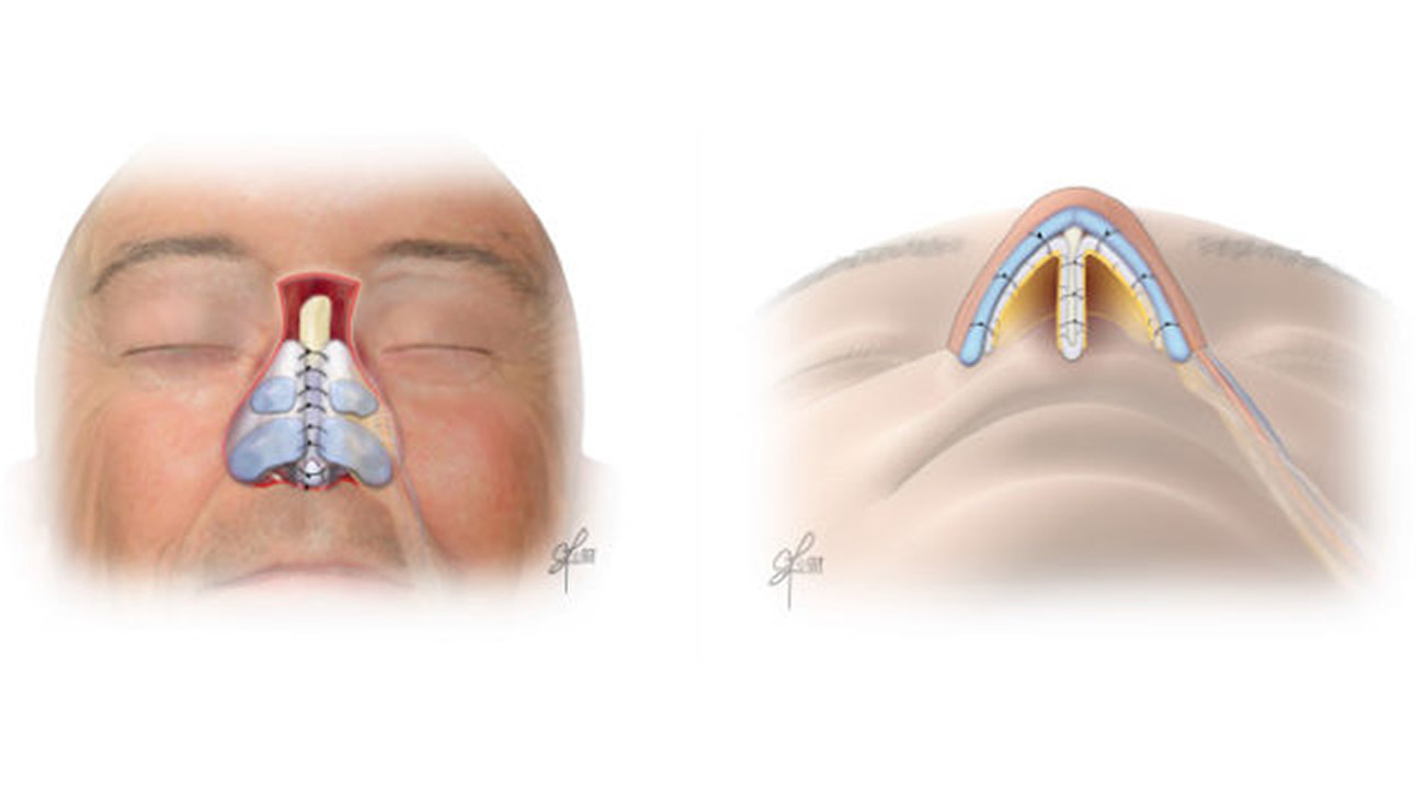 Cleveland Clinic doctors built the new structure for Jerry's nose using bone and cartilage taken from his rib and ear, wrapping those with tissue called fascia lata. They then used a flap of skin from his forehead to provide a new surface for the nose. (Courtesy: Cleveland Clinic)