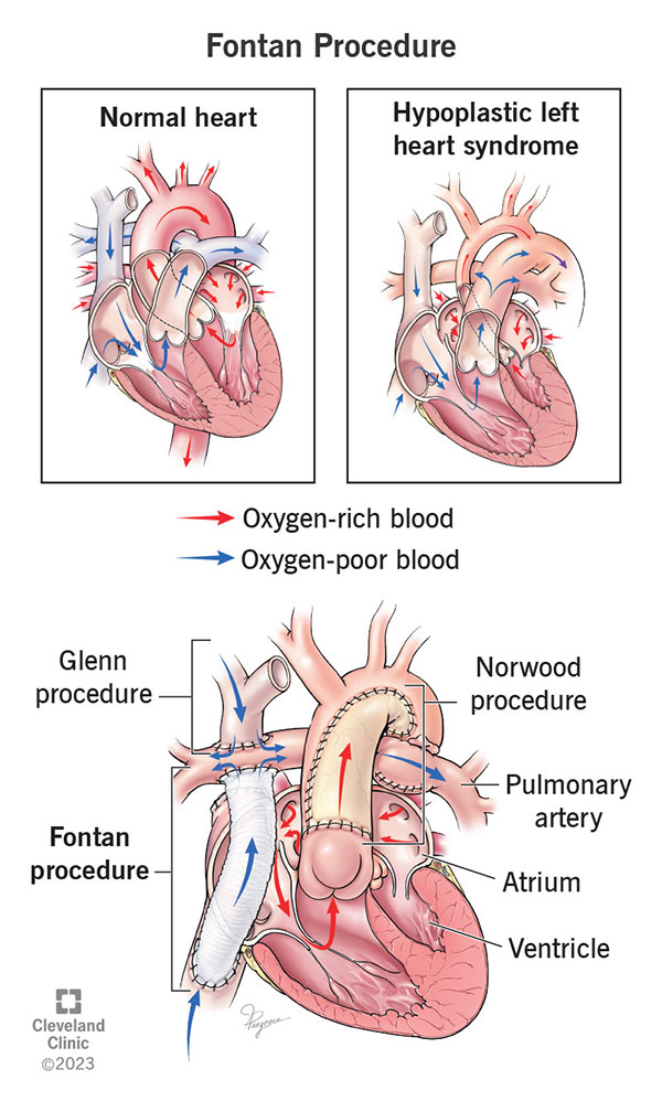 A Fontan procedure lets oxygen-poor blood from the lower body bypass the heart and go straight to the pulmonary artery.