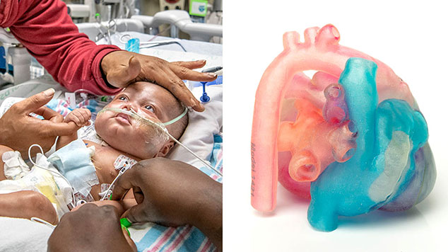 Infant’s remarkable ventricular surgery repairs congenital heart defect.