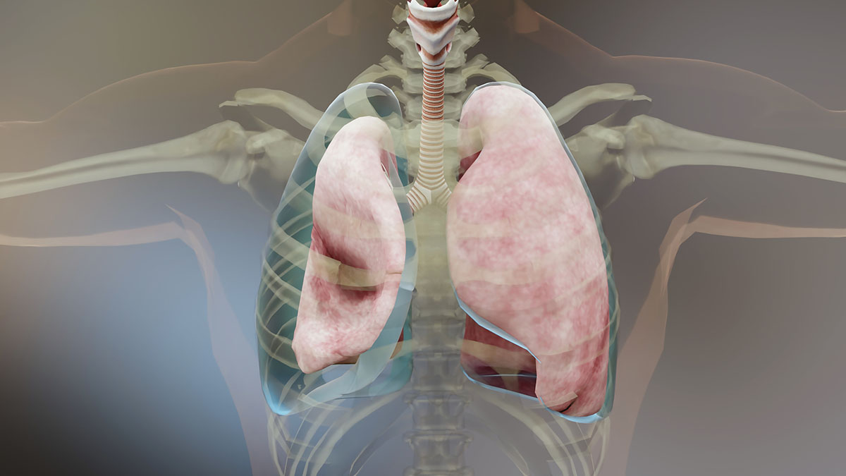 Pneumothorax - collapsed lung - Causes - Symptoms - Diagnosis - Treatment - options - Best - Homeopathic - doctor - in - Pakistan - Dr - Qaisar - Ahmed - Dixe - cosmetics