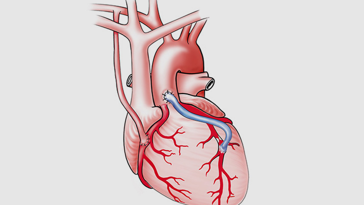 Coronary Artery Bypass Surgery