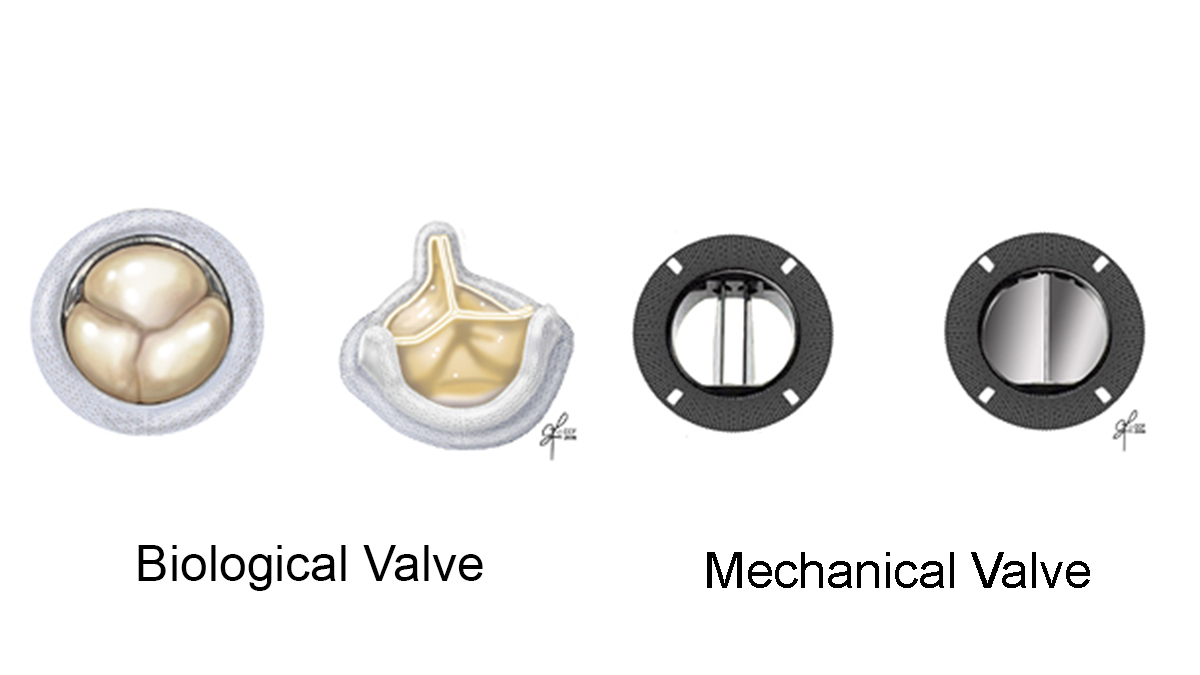 Bio and Mech Valves