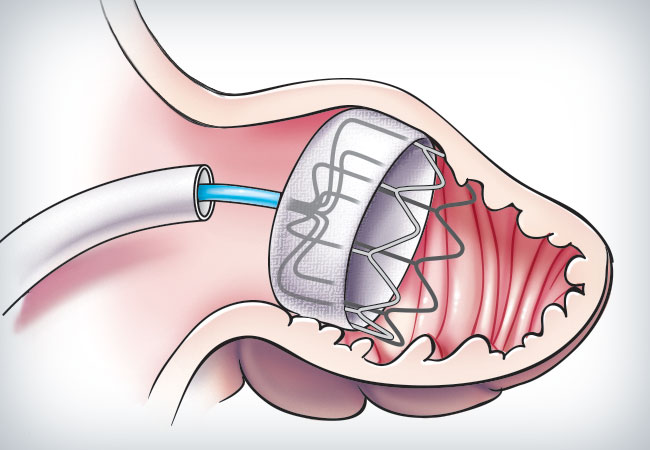 Left Atrial Appendage Closure