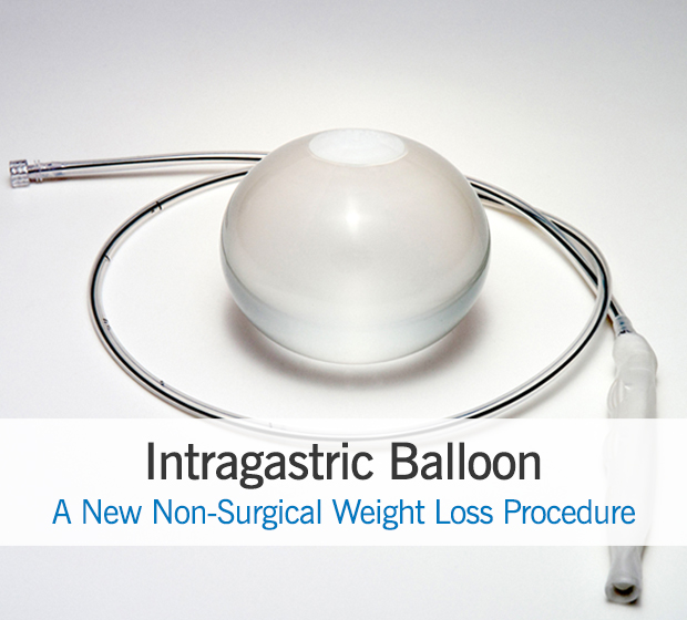 Intragastric Balloon | Cleveland Clinic