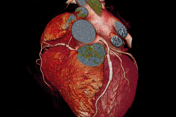 C5Research Cardiovascular Imaging | Cleveland Clinic