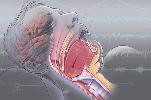 Sleep Disorders Research Programs | Cleveland Clinic