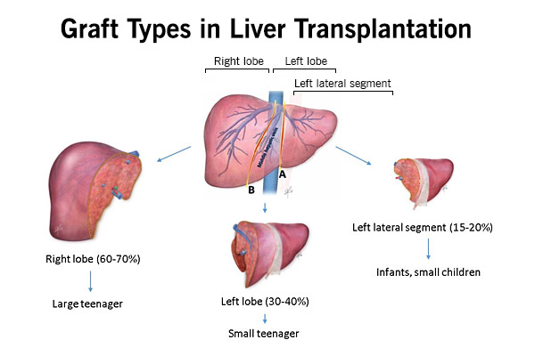 Pediatric Liver Transplant Program | Liver Transplant | Cleveland Clinic