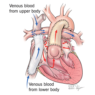 Pediatric HLHS Fontan Operation