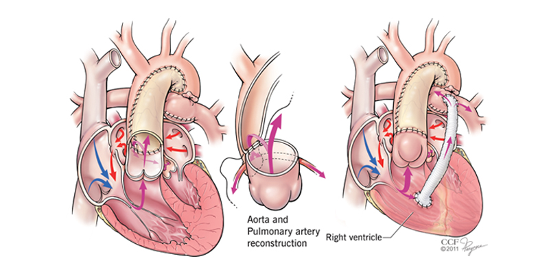 Pediatric HLHS Norwood Operation