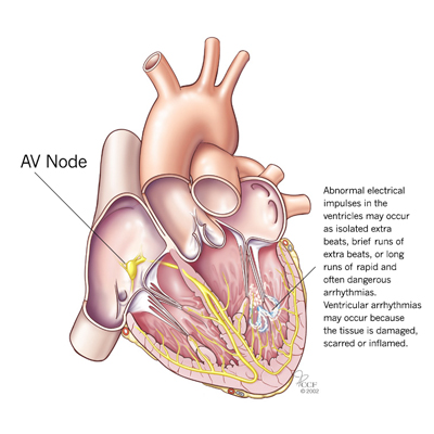 A Ventricular Arrhythmia Begins In The Lower Chambers Of The Heart