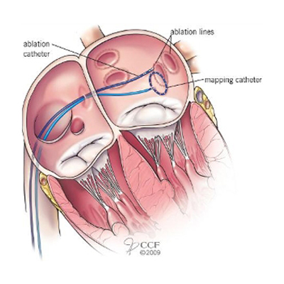 Pulmonary Vein Ablation for AFIB