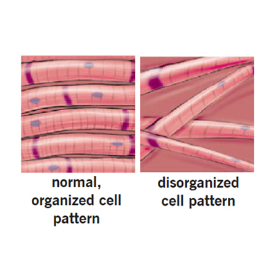 Hypertrophic Cardiomyopathy Cellular Changes